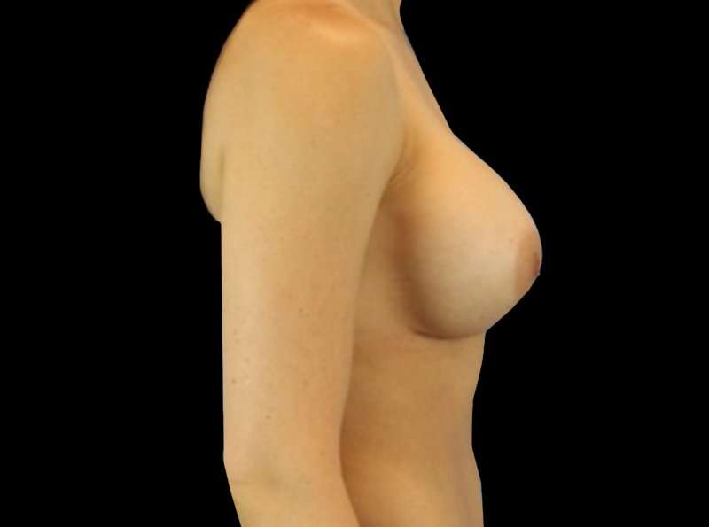 Revision Breast Surgery Before & After Patient #1184