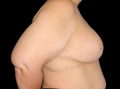 Revision Breast Surgery Before & After Patient #1195