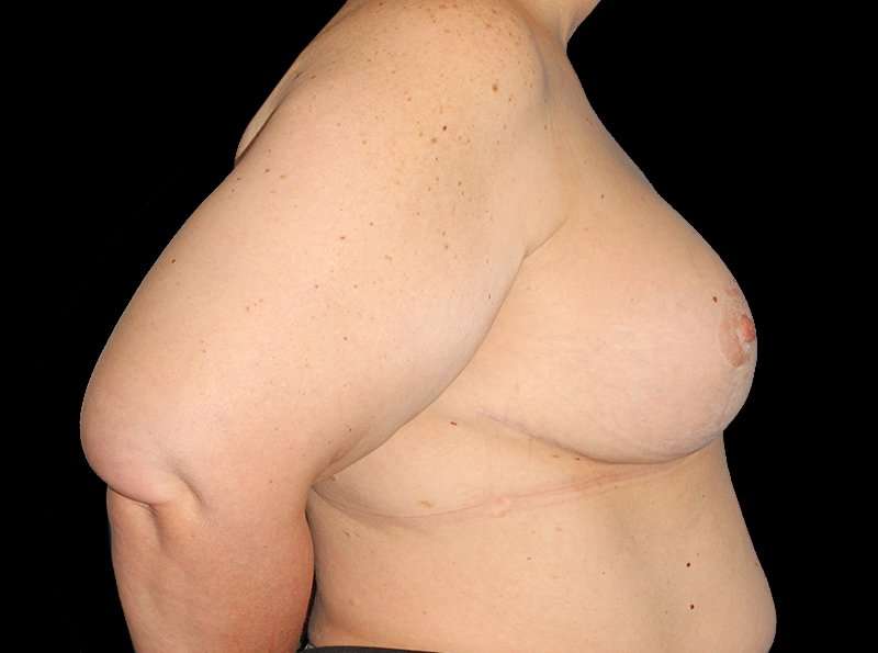 Revision Breast Surgery Before & After Patient #1195