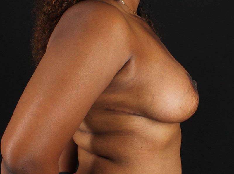 Breast Reduction Before & After Patient #1217