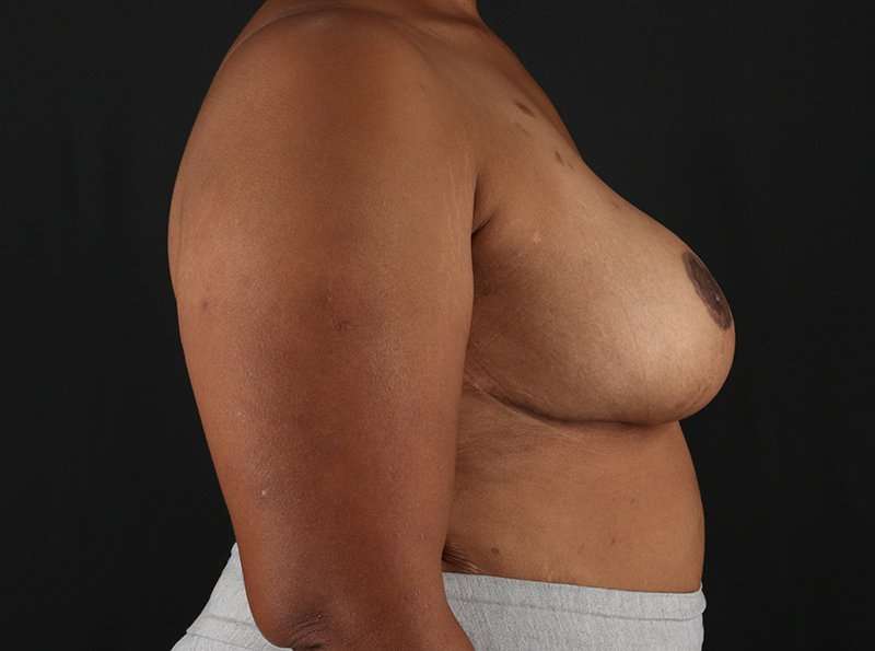 Breast Reduction Before & After Patient #1228
