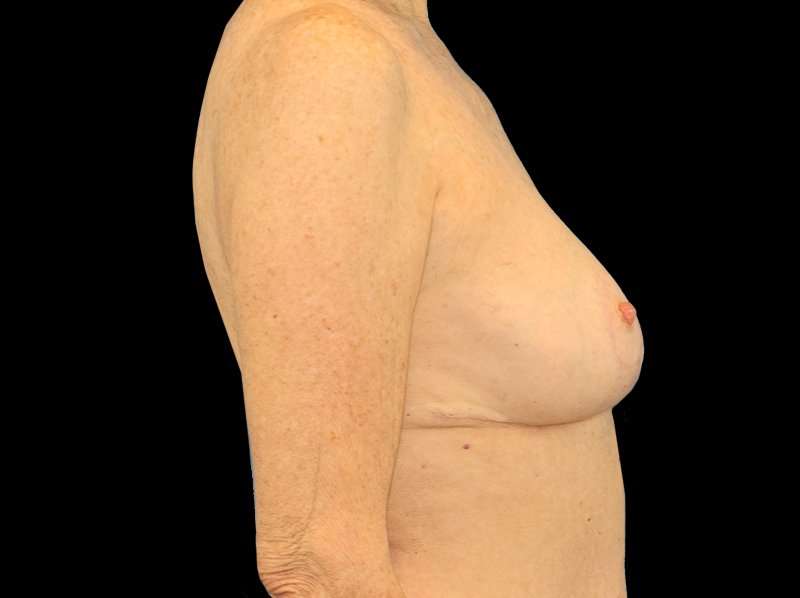 Breast Reduction Before & After Patient #1239