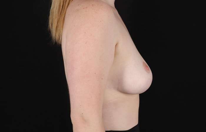 Breast Reduction Before & After Patient #1250