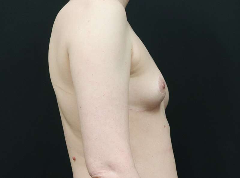 Breast Reduction Before & After Patient #1261