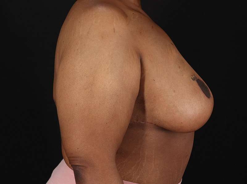 Breast Reduction Before & After Patient #1272