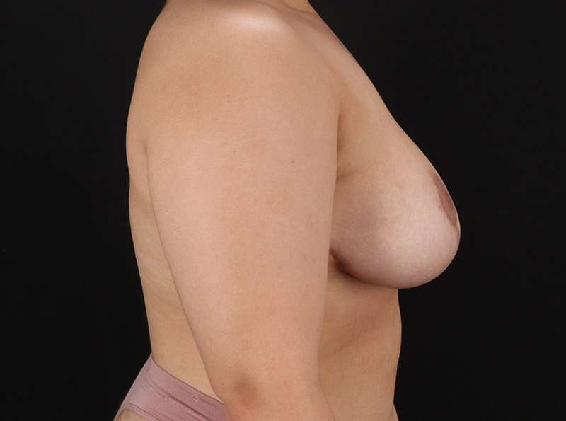 Breast Reduction Before & After Patient #1283
