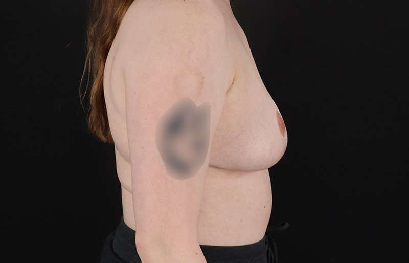 Breast Reduction Before & After Patient #1305