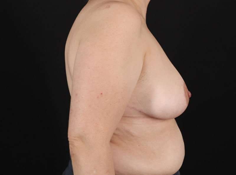 Breast Reduction Before & After Patient #1321