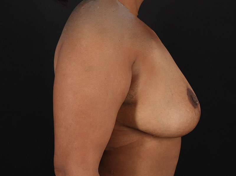 Breast Reduction Before & After Patient #1387
