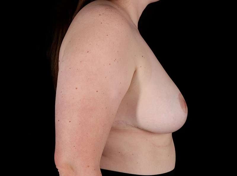 Breast Reduction Before & After Patient #1409