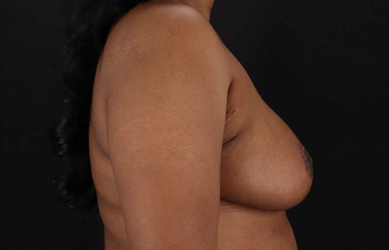 Breast Reduction Before & After Patient #1431