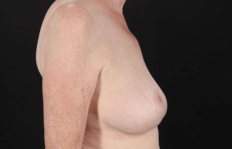 Breast Reduction Before & After Patient #1442