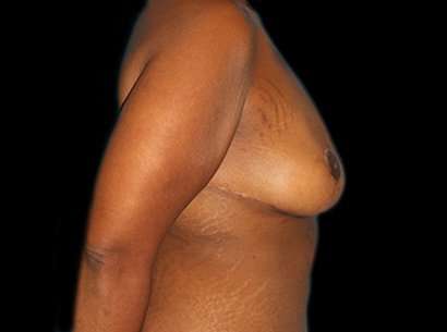 Breast Reduction Before & After Patient #1486