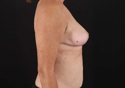 Augmentation/Lift Before & After Patient #1504