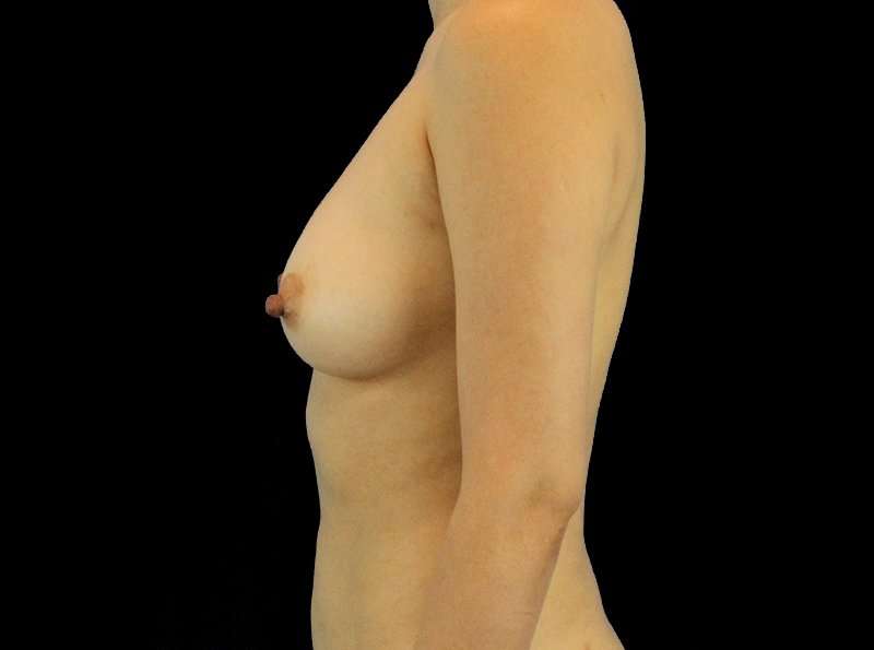 Breast Augmentation - Fat Transfer Before & After Patient #1511