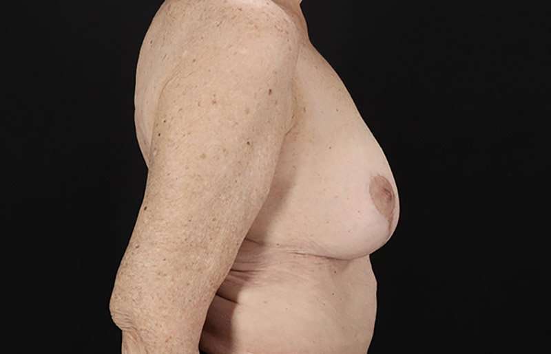 Augmentation/Lift Before & After Patient #1544