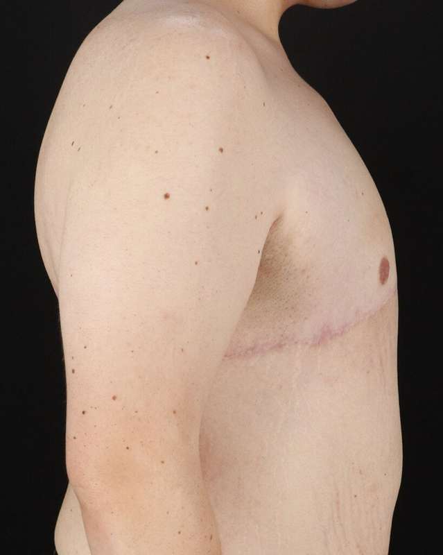 Gynecomastia Before & After Patient #1603