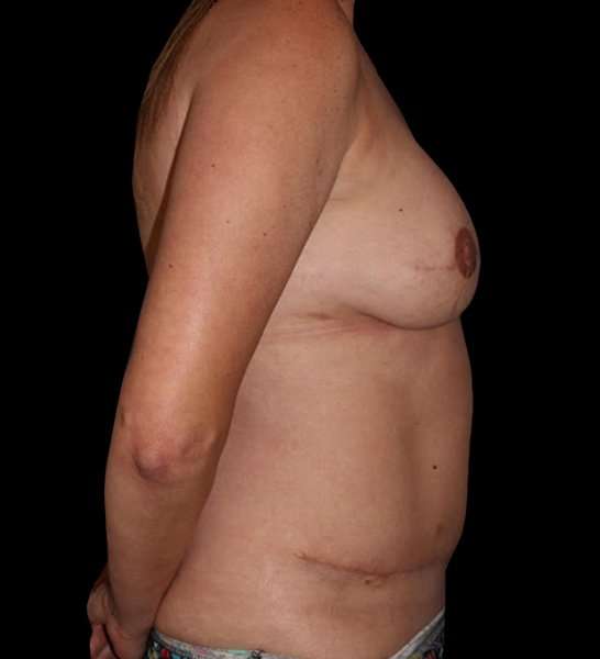 DIEP Flap Reconstruction Before & After Patient #1652
