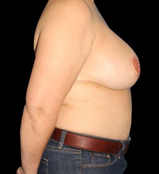 DIEP Flap Reconstruction Before & After Patient #1663