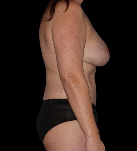 DIEP Flap Reconstruction Before & After Patient #1674