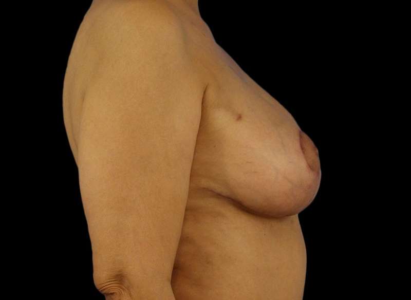 DIEP Flap Reconstruction Before & After Patient #1707
