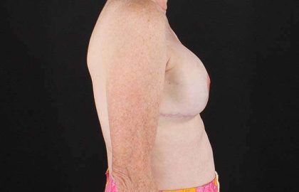 Implant Based Breast Reconstruction Before & After Patient #1718