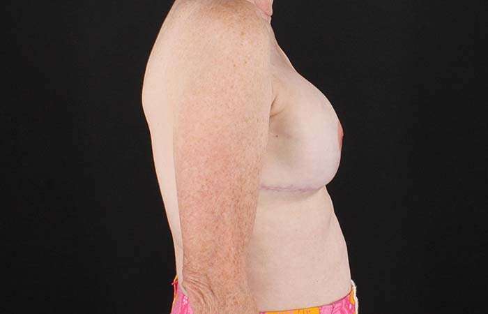 Implant Based Breast Reconstruction Before & After Patient #1718