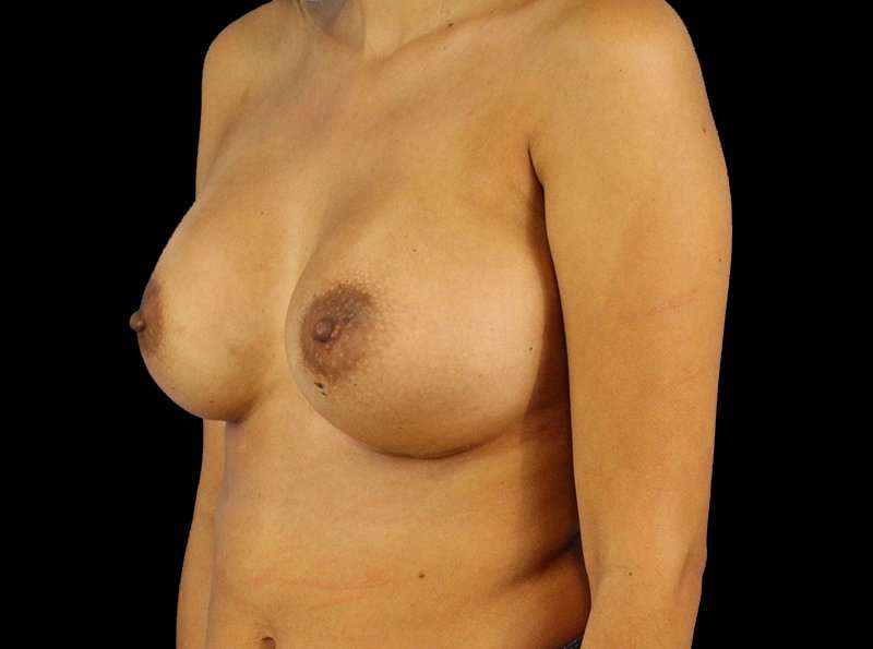 Breast Augmentation - Implant Before & After Patient #961