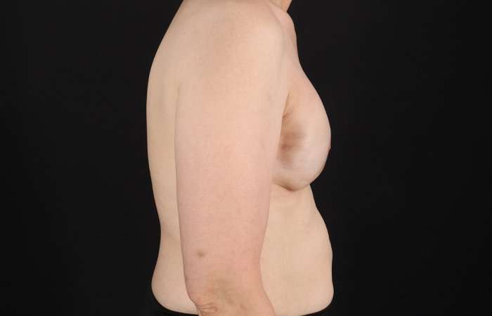 Implant Based Breast Reconstruction Before & After Patient #1740