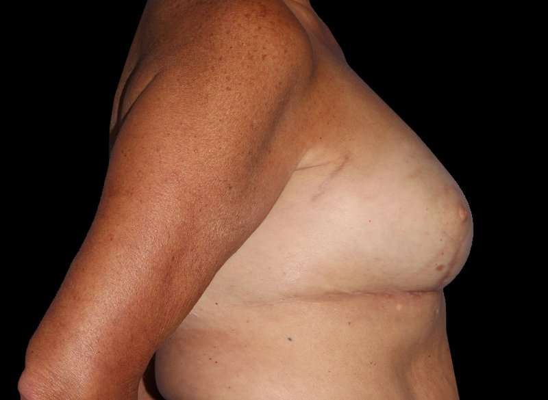 Oncoplastic Reconstruction Before & After Patient #1762