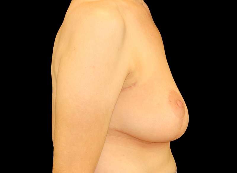 Oncoplastic Reconstruction Before & After Patient #1773