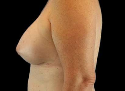 MTF Breast Augmentation Before & After Patient #1802