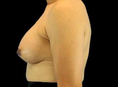 MTF Breast Augmentation Before & After Patient #1809