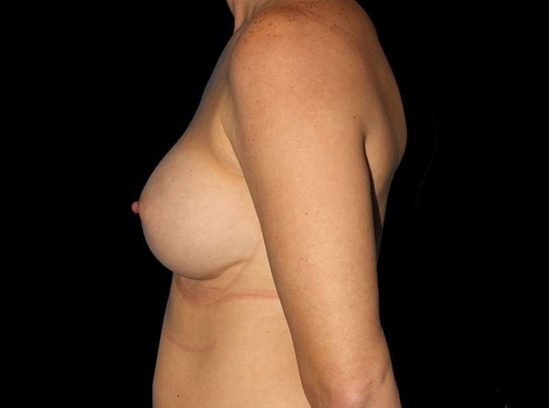 Breast Augmentation - Implant Before & After Patient #968