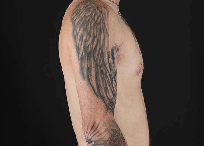 FTM Chest Contouring Before & After Patient #1864