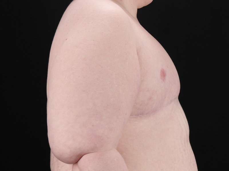 FTM Chest Contouring Before & After Patient #1875