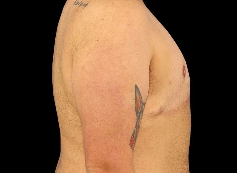 FTM Chest Contouring Before & After Patient #1886