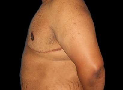 FTM Chest Contouring Before & After Patient #1893