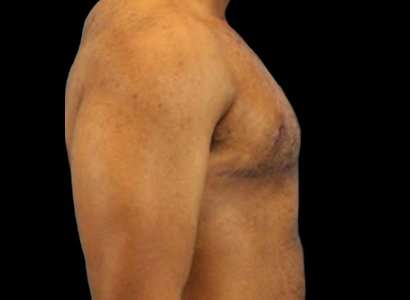 FTM Chest Contouring Before & After Patient #1907