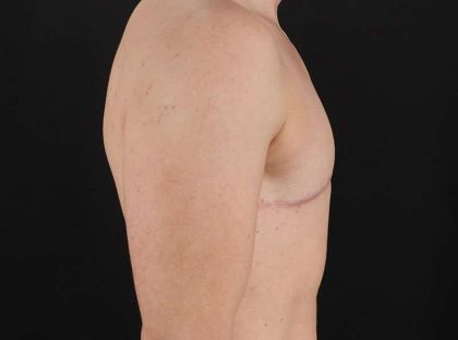 FTM Chest Contouring Before & After Patient #1918