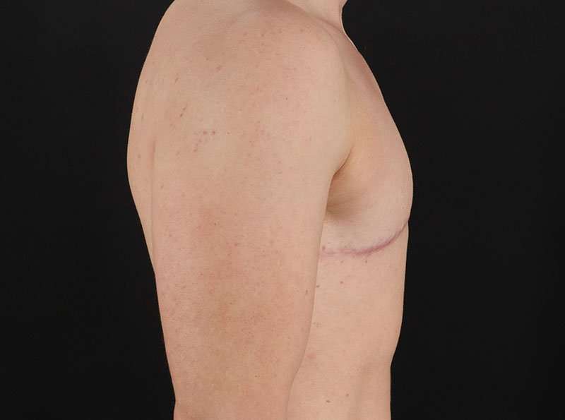FTM Chest Contouring Before & After Patient #1918