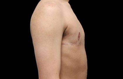 FTM Chest Contouring Before & After Patient #1929