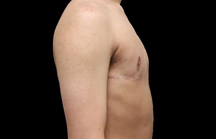 FTM Chest Contouring Before & After Patient #1929