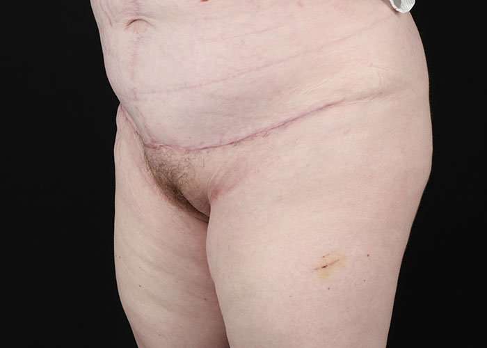 Monsplasty Before & After Patient #2106