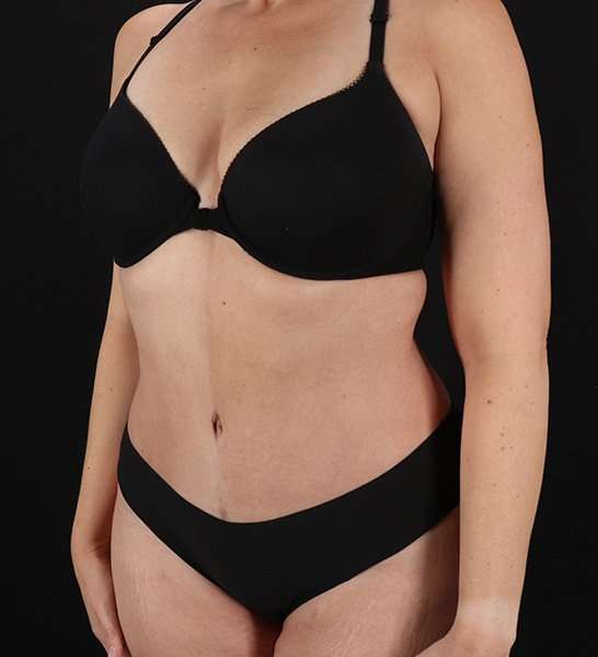 Tummy Tuck Before & After Patient #2128