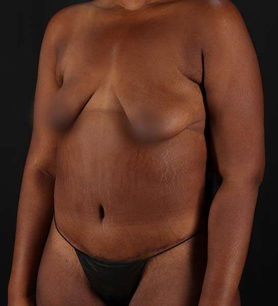 Tummy Tuck Before & After Patient #2139