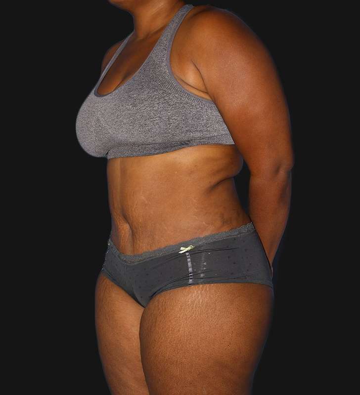 Tummy Tuck Before & After Patient #2179