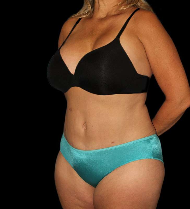 Tummy Tuck Before & After Patient #2190