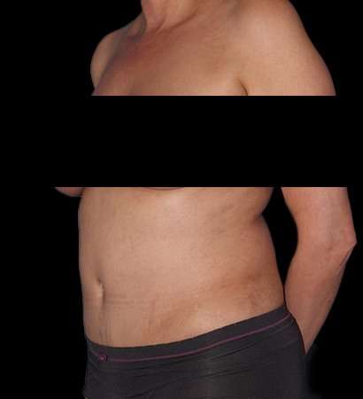 Tummy Tuck Before & After Patient #2201