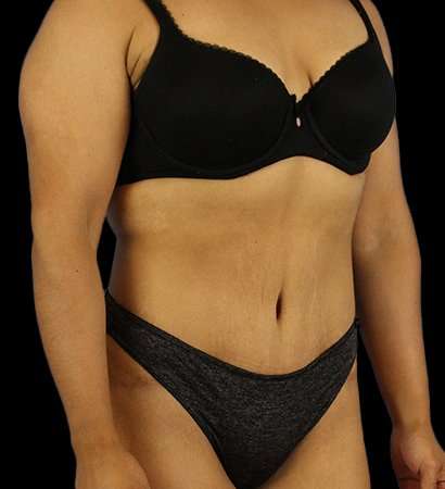 Tummy Tuck Before & After Patient #2212